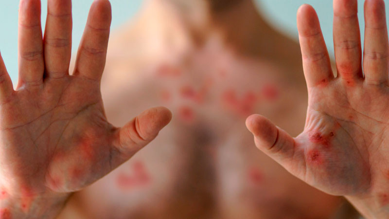 Confirman dos casos de Mpox en Sonora 