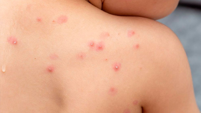 Reporta SSa 114 contagios de mpox en 2024 