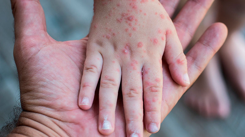 Oaxaca registra 4 casos de sarampión; activa cerco sanitario 