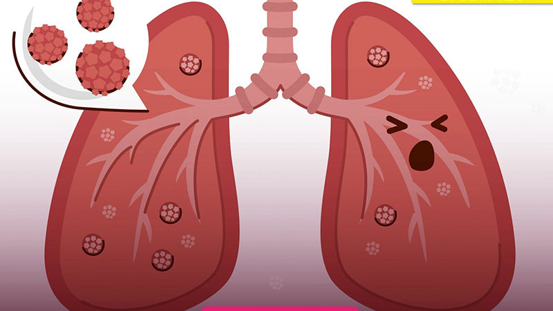 Prevención y detección, claves para combatir la tuberculosis: sector salud 