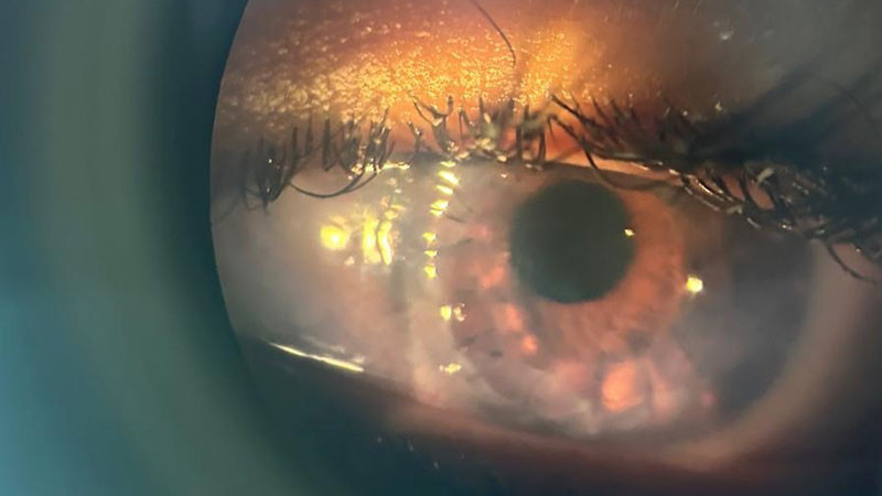 ¡Cuida a tus ojos del sol!: médicos dan recomendaciones 