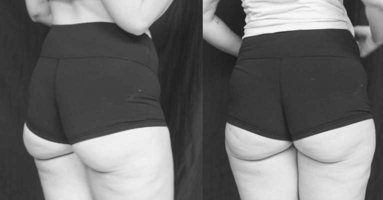  #Cellulitesaturday, nuevo reto en redes sociales  - Foto 0 