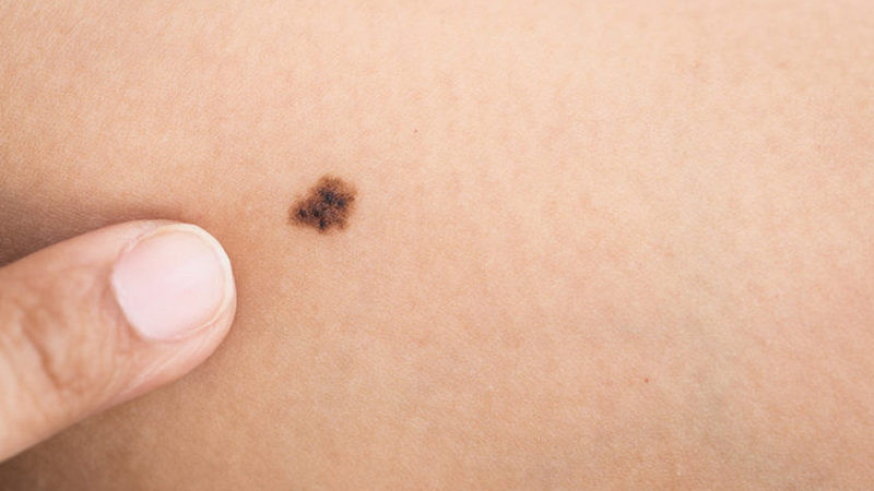 Aprueban inmunoterapia dual para mexicanos con melanoma avanzado 