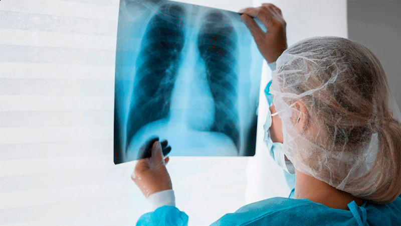 205 contagios y 12 muertes por tuberculosis en Nuevo Laredo, Tamaulipas 
