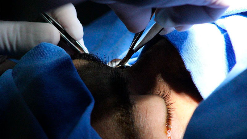 Realizan 292 cirugías de cataratas en mega jornada en el IMSS Querétaro  