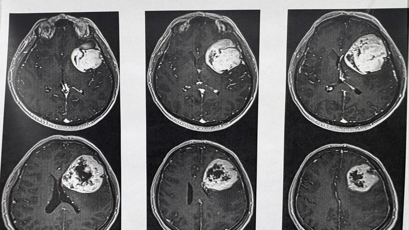 Retiran tumor cerebral con técnica de paciente despierto en el CMN “20 de Noviembre” del ISSSTE 