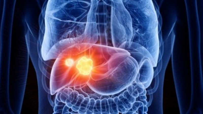 Se suma SESA a la conmemoración del Día Mundial del Cáncer de Hígado 