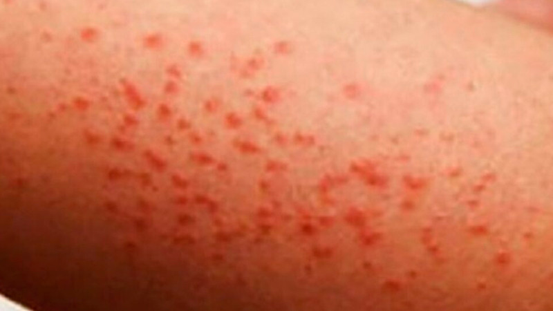 Morelos detecta 13 casos importados de sarampión; van más de 5 mil a nivel nacional 