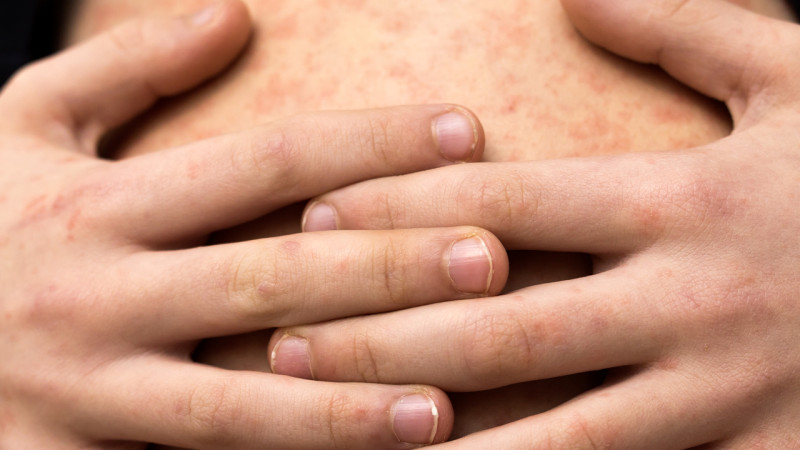 El sarampión es una enfermedad prevenible por vacunación 