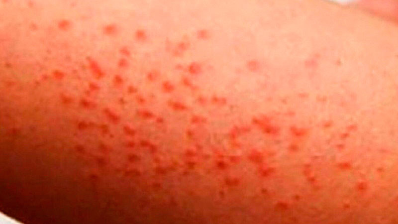 Se registra el primer fallecimiento por sarampión en Jalisco  