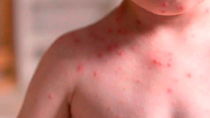 Confirman 5 nuevos casos de sarampión en la CDMX 
