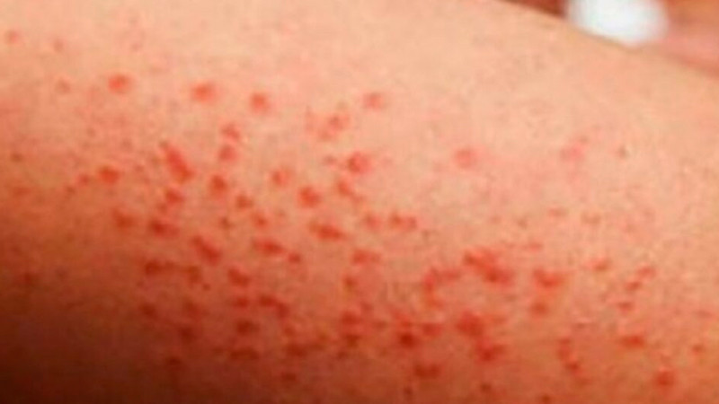 Confirman el fallecimiento de un menor de edad en Tlaxcala, a causa de complicaciones por sarampión 