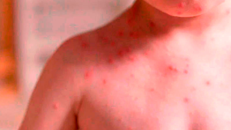 Aumentan en más de 120 los casos de sarampión en la CDMX entre diciembre y enero 