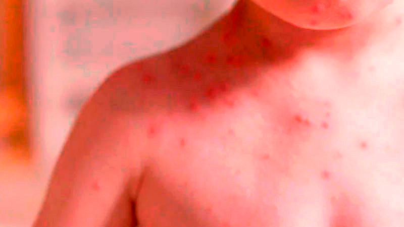 Suspenden clases en dos estados por brotes de sarampión 