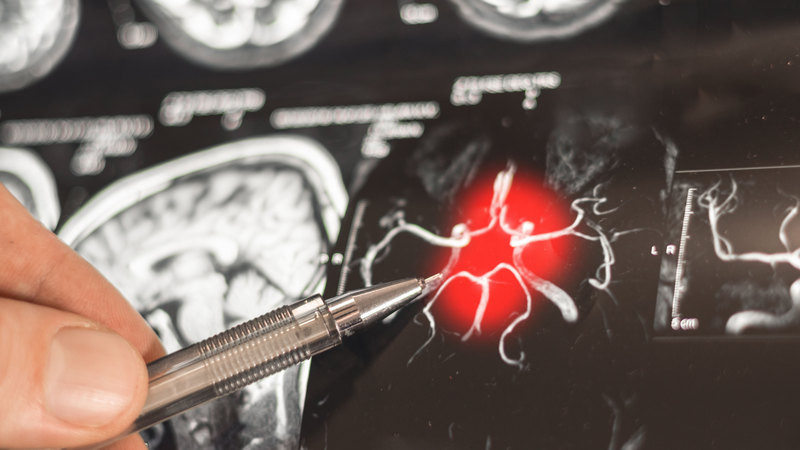 Cirugía y neuroestimulación logran controlar la epilepsia en el 80% de los casos difíciles 