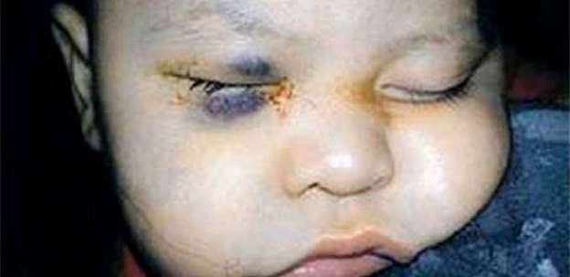 Extirpan ojo sano a bebé de 14 meses en hospital de Sonora 