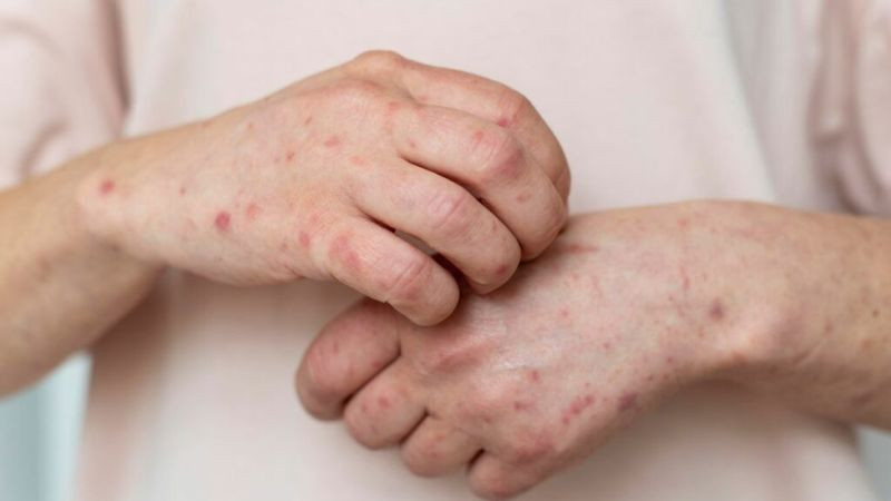Nueva York activa emergencia sanitaria ante repunte de sarampión 