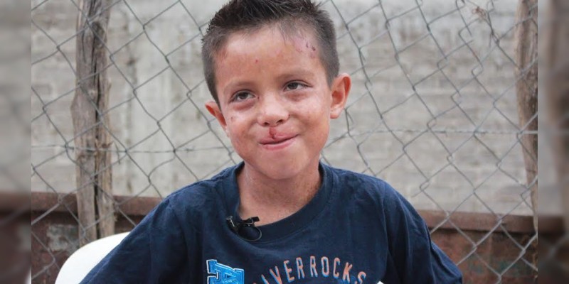 Santiago, primer niño michoacano, operado ”a corazón abierto“, en el ISSSTE de Morelia 