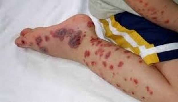 Se registran 102 nuevos casos de chikungunya en Michoacán; suman 518 