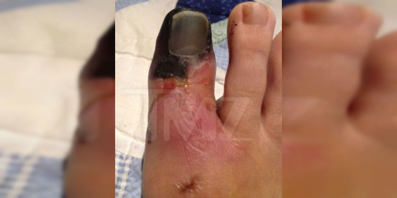 Demandan a Katy Perry  por millonaria cifra de dinero, por su culpa asistente pierde un dedo del pie  - Foto 1 