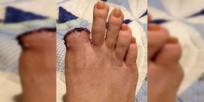 Demandan a Katy Perry  por millonaria cifra de dinero, por su culpa asistente pierde un dedo del pie  - Foto 2 