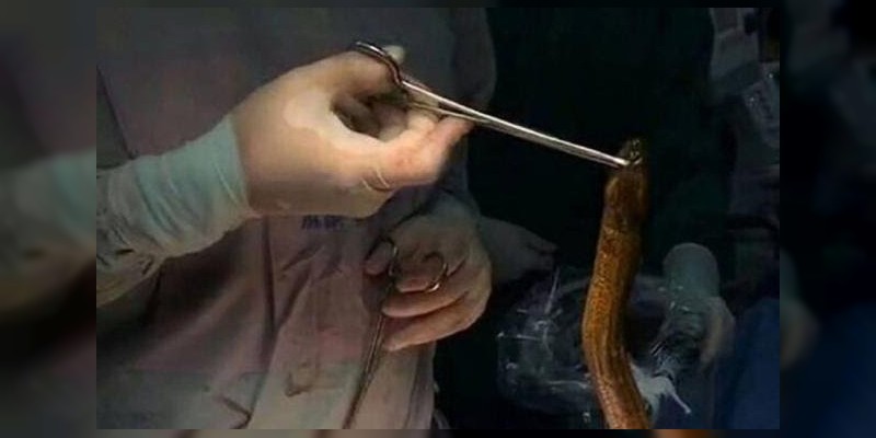 Encuentran anguila gigante en el intestino de un hombre