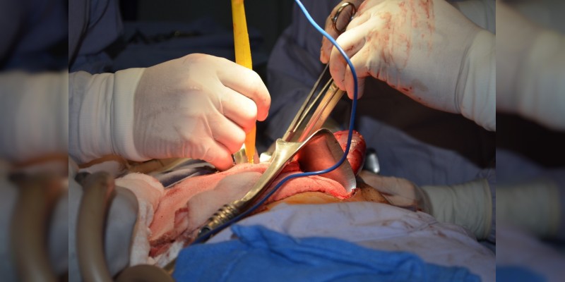 Se realiza exitoso trasplante renal número 80 en el Hospital General de Uruapan  
